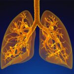 Pulmones afectados por la silicosis