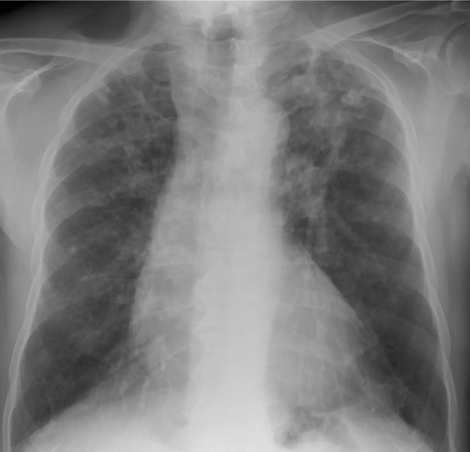 如何诊断人造石硅肺病？