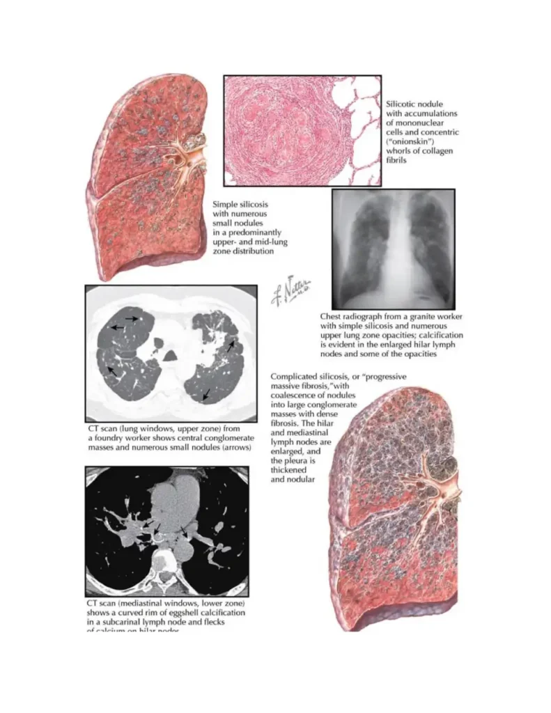 silicosis netter